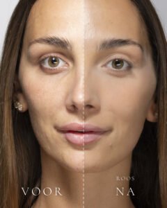 Links het gezicht zonder make-up, rechts met Loose Setting Powder in de tint Roos
